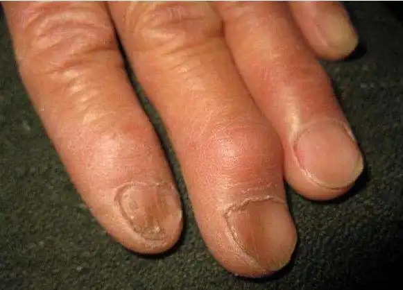 指甲这3个信号是肝癌的预兆养肝排毒简单3个方法即可