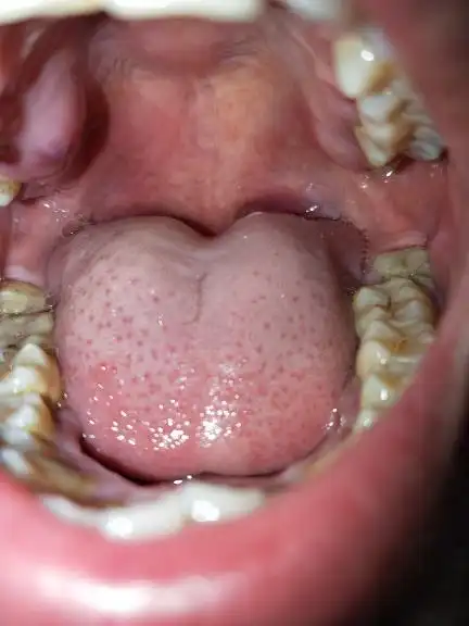 昨天开始牙龈肿,喉咙不舒服,吞口水有点痛,到拿药,吃了一天药牙龈还是