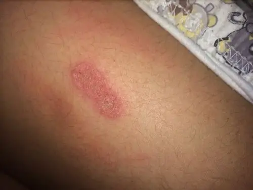 了点皮 就没在意 现在伤口变成这样 周围还很痒 凸了起来 左边还被我