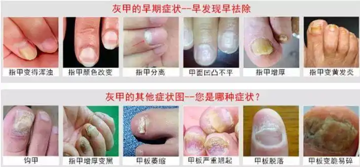 也可以由真菌直接感染甲板所致灰指甲多由资深的手癣,足癣传染而来