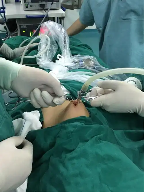 赤峰宁城中心医院普外二病区(胃肠外科)首例腹腔镜下疝囊高位结扎术