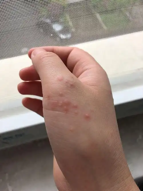 手上长了好多这样的类似水泡的东西 特别的痒 去药店拿了999 但没有用