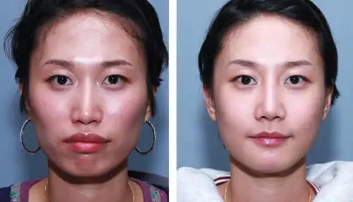 突嘴矫正对比图