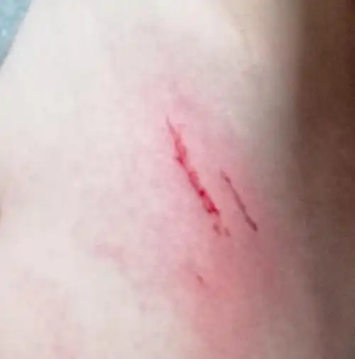 被猫抓伤了,碍不碍事