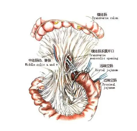 消化道重建有多种方式,常用的食管空肠吻合术和代胃术两种方式