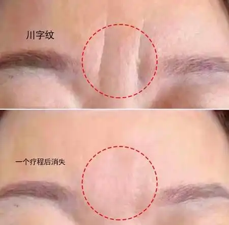 做完川字纹手术会复发吗?了解川字纹动态和静态两种类型