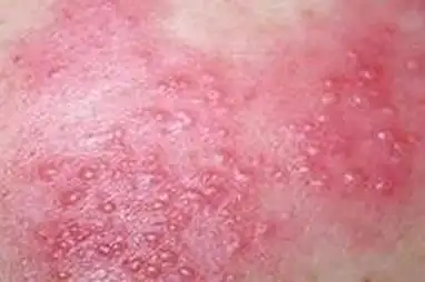 皮肤病名老中医胡爱玲急性湿疹双脚起水泡糜烂肿胀行走