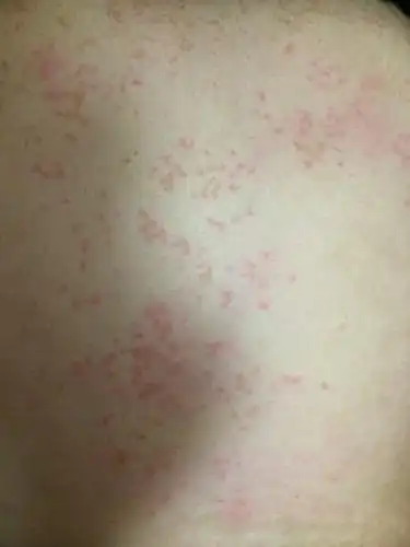 前胸后背成片的小红疙瘩!那天吃了两口鱼子,晚上就开始起!