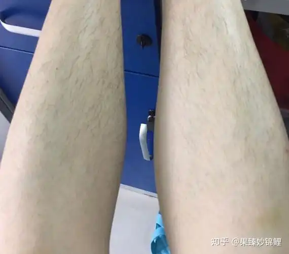 脱腿毛真的会越长越长吗