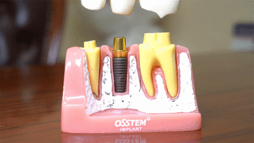 种植牙|种牙|口腔_网易订阅