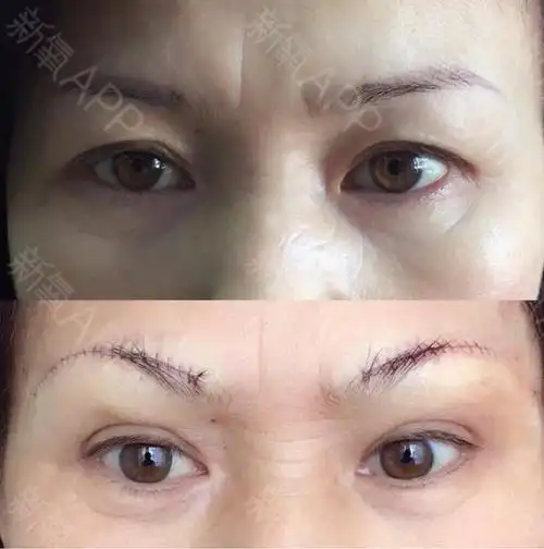 切眉后久恢复自然正常组织在切眉手术后恢复期一般为1_圈子-新氧美容