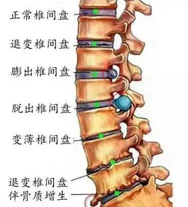 武汉骨科医院有名的专家柳新樵腰椎间盘突出腰痛大小腿放射性痛中医