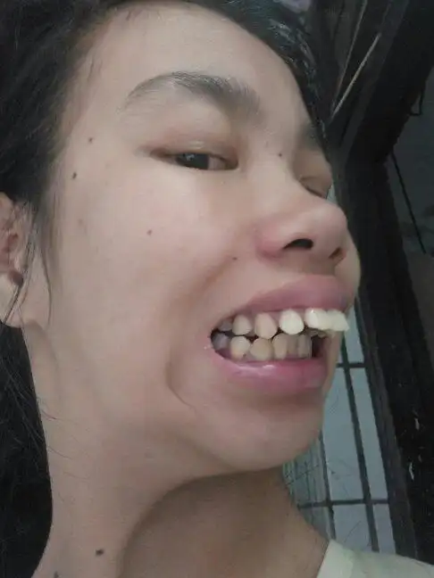 大龅牙龅出来还能矫正吗