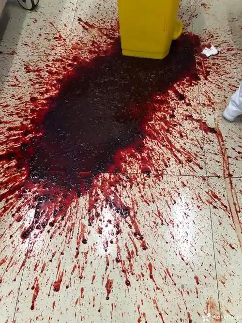 肝炎肝硬化胃食管底部静脉曲张失血性休克呕血半小时