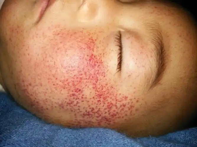 宝宝脸部过敏发红图片,新生儿脸过敏发红怎么办?-图片大观-奇异网