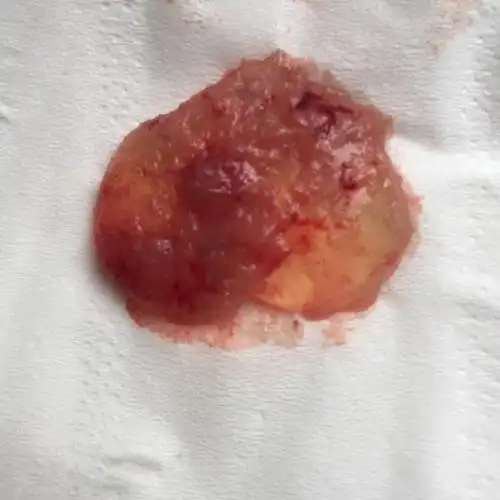 早孕药流排出的孕囊形状图片