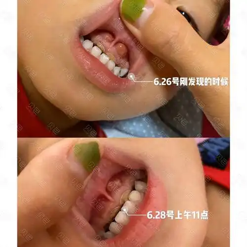 宝宝牙齿出泡怎么回事有人说是根尖发炎