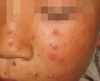 宝宝出水痘怎么办