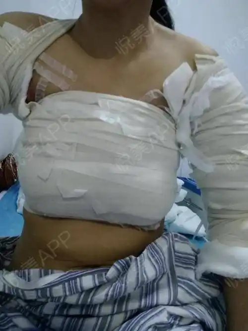 乳房下垂矫正术后1天_假体隆胸术后1天_胸型美化术后1天_隆胸术后1天