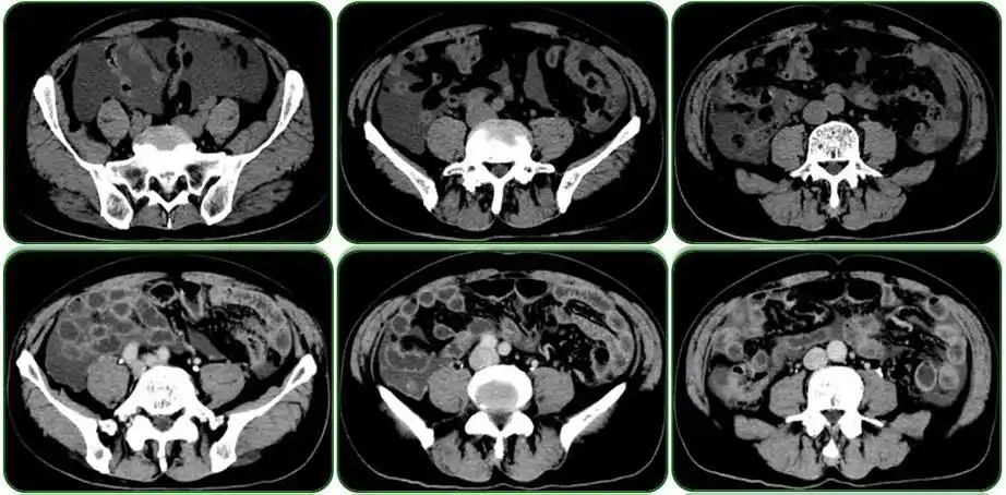 3个病例8副图带你读懂腹水