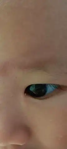 请问有知道宝宝眼角长的小白粒是什么吗?