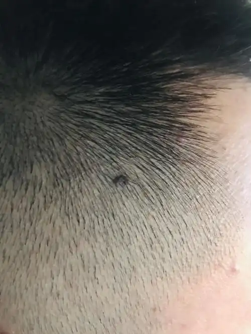 老公身上本来就多痣,前几天推头,发现头上有个痣,颜色不均匀,也许