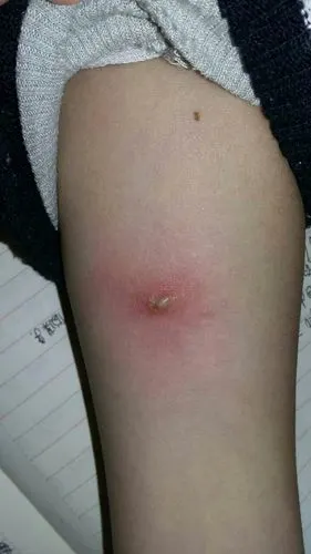 急求医… …虫子咬的,怎么会这样?