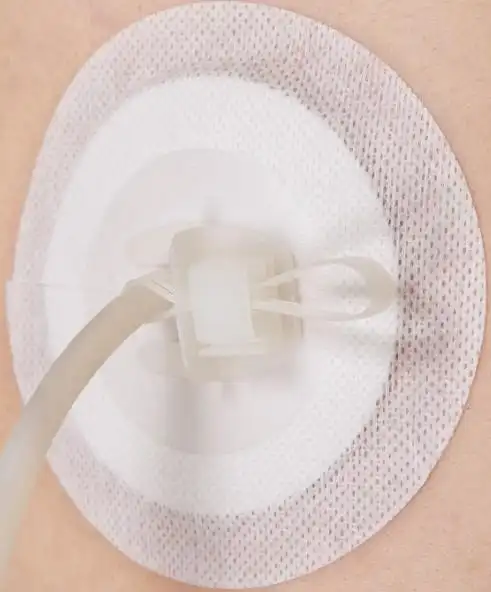 引流管固定(锁条型)