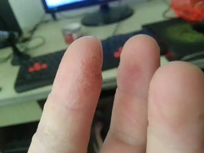 1,手上长小水疱可见于汗疱疹或者是水疱型手癣,汗疱疹是湿疹的一个