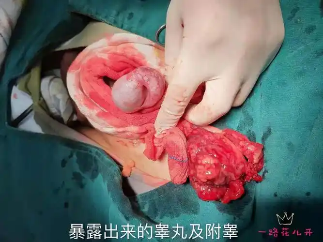 急腹症之嵌顿疝