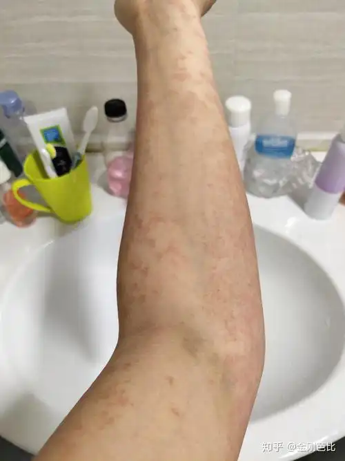 得了多形性红斑,怎么才能痊愈啊?要忌什么吗? - 知乎