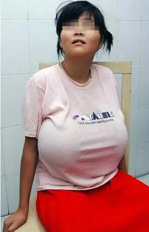 王晓东说,他做过近50例巨乳缩小术,大部分病人是因隆胸手术后出现了