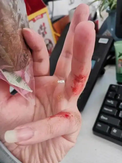 被五步蛇咬伤然后继续去上班了