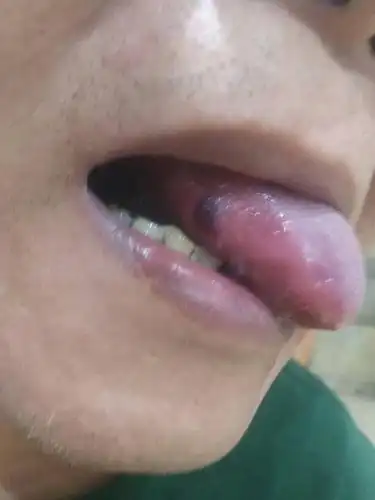 舌头下面突然起了一个血泡,会越来越大吗