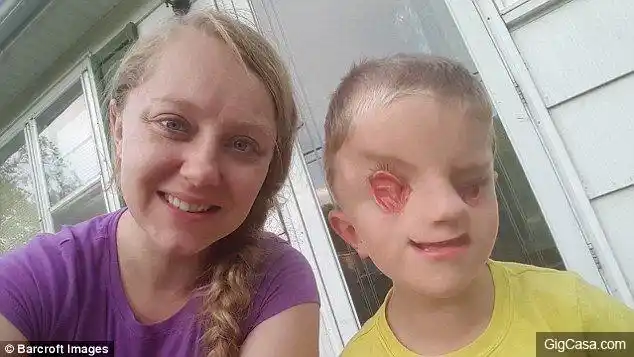 6岁男童「眼睛裂开畸形」惨遭歧视,仍乐观生活!