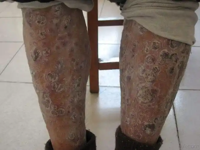 梅毒图片_梅毒症状表现图片大全_有来医生