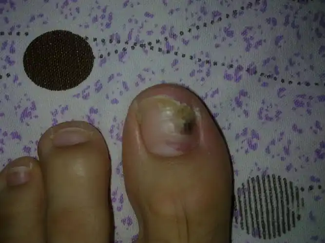 请问脚指甲里有黑色不明物,抠不出来,而且越长越靠里边(以前没这么靠