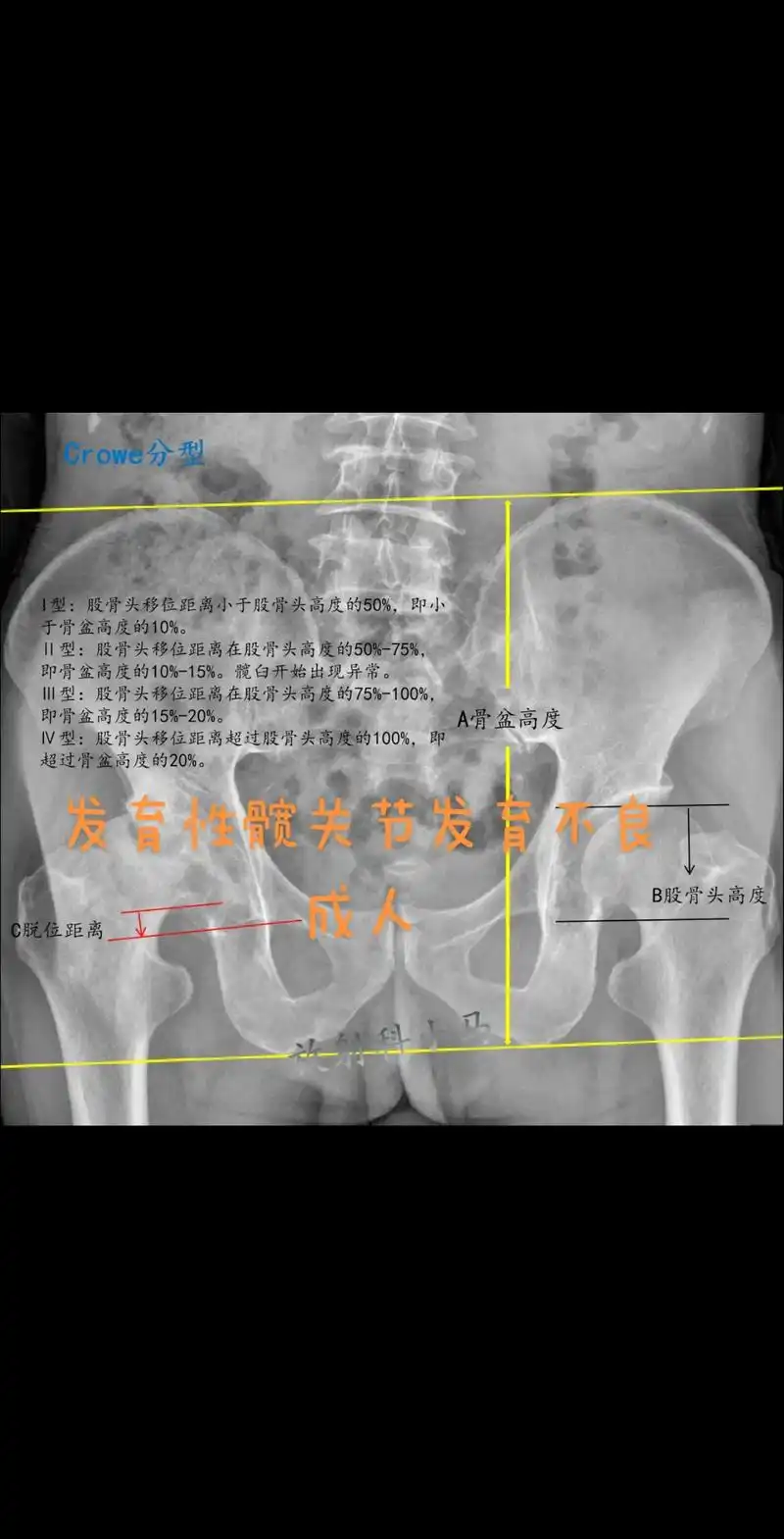 发育性髋关节发育不良ddh-成人.发育性髋关节发育不良(dd - 抖音