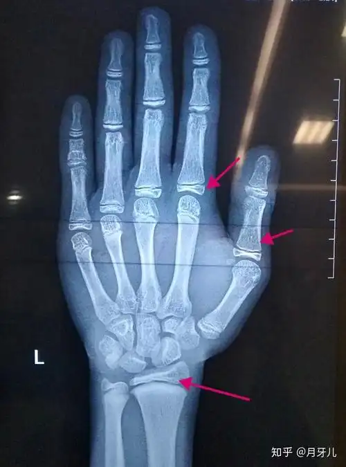 骨骺线算闭合了吗?