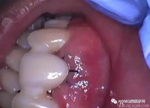 一例根尖脓肿,浅谈误诊误治