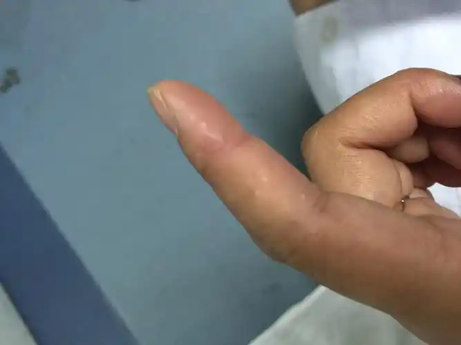 每年夏天手指侧面都会起小水泡的东西每个手指都有不知道是不