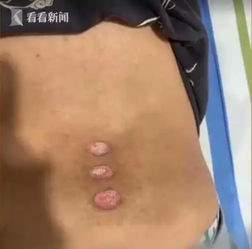 腰痛怕手术听信偏方15岁男孩腰上烂了三个洞