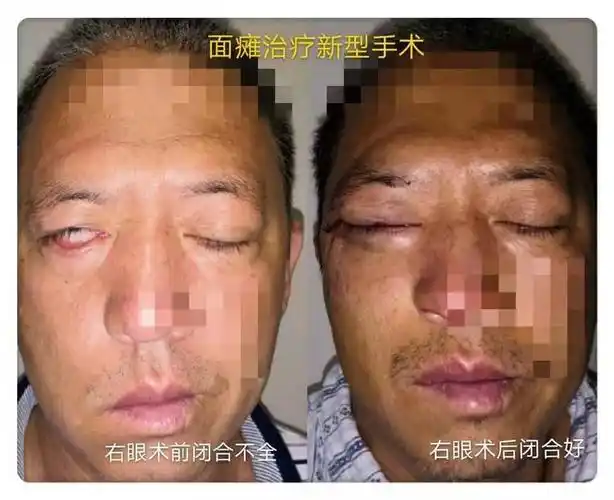成人知觉性斜视术前,术后对比