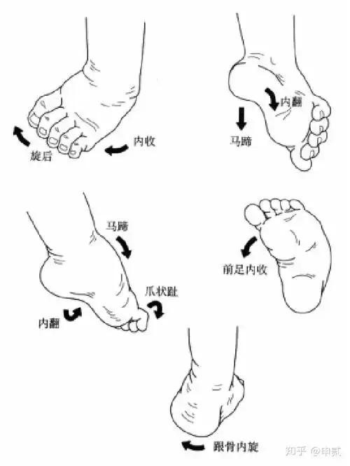 儿童马蹄内翻足的康复
