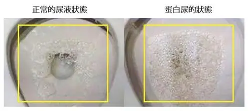 且,蛋白尿从间歇性会逐渐发展为持续性.