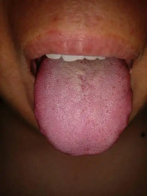 舌苔发白怎么回事,感觉有点厚了都