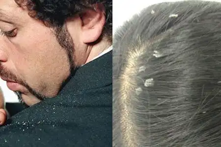 【图】头皮屑多怎么办才好 学会4招助你轻松解决问题