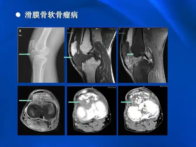 滑膜骨软骨瘤病