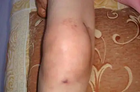 滑膜炎情况不同,表现症状也是不太一样的:轻度症状以关节疼痛为主