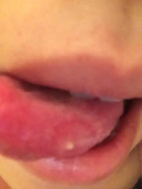 请大伙帮忙看看:今天,我的舌头长了一个白色小疙瘩,摸的时候有点酸疼